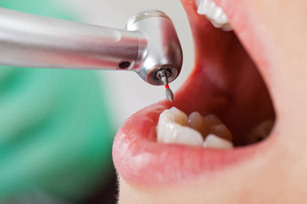 Best Emergency Treatment for Dental Infections or Abscesses in Vandalia, OH